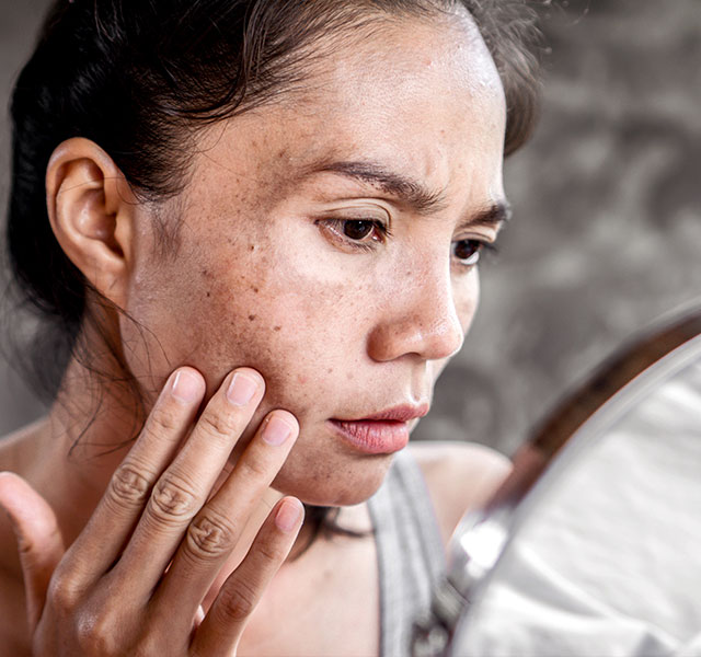 Hyperpigmentation face cheap
