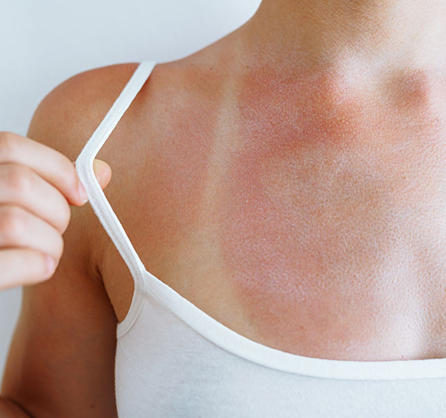 sun sensitivity