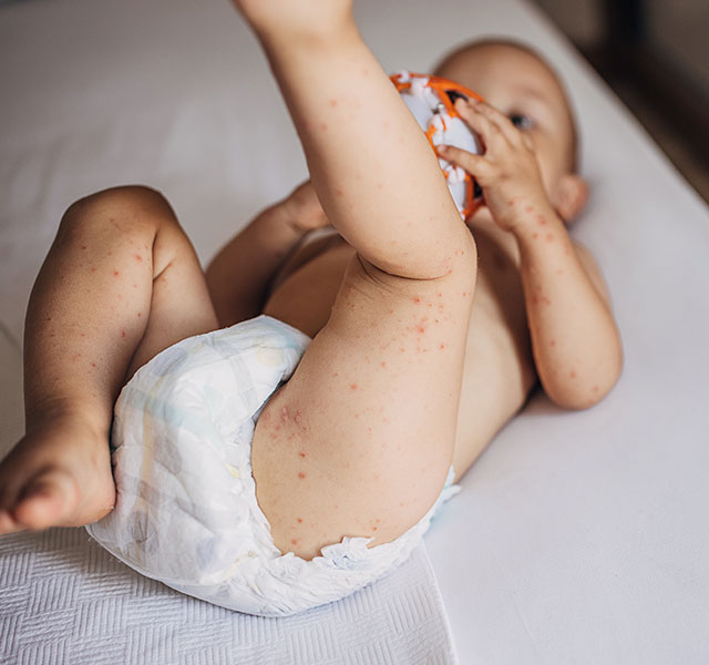 hand food mouth disease