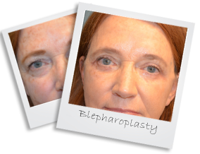 blepharoplasty823