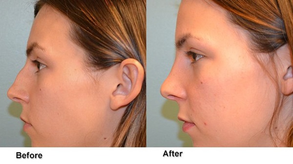 deeb rhinoplasty 5