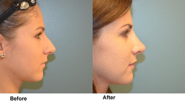 deeb rhinoplasty 6