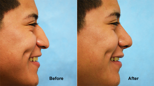 deeb rhinoplasty 8