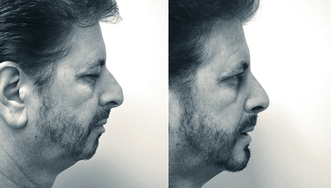 Side profile of man before and after rhinoplasty and chin implant