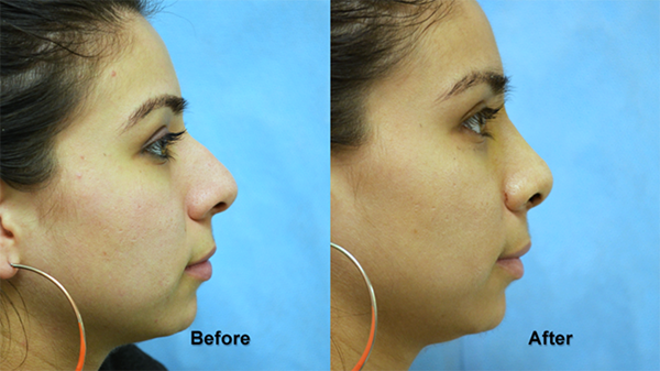 deeb rhinoplasty