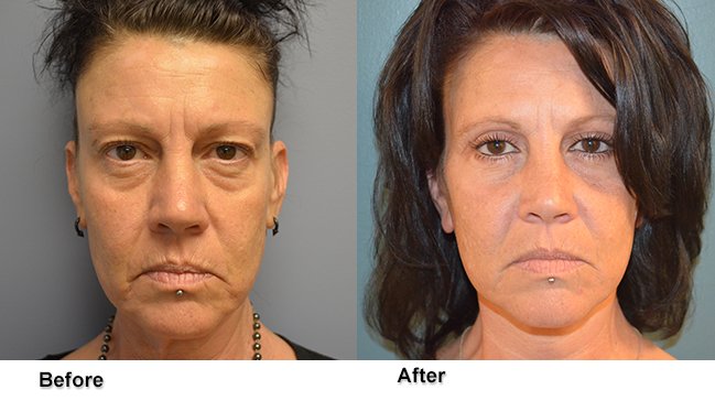 Front profile of woman before and after upper eyelid surgery