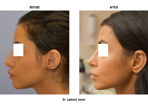 Side profile of woman before and after rhinoplasty