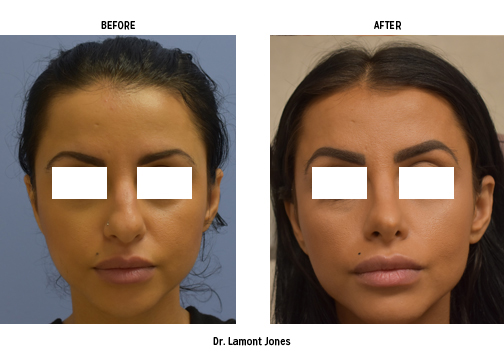 Front profile of woman before and after rhinoplasty