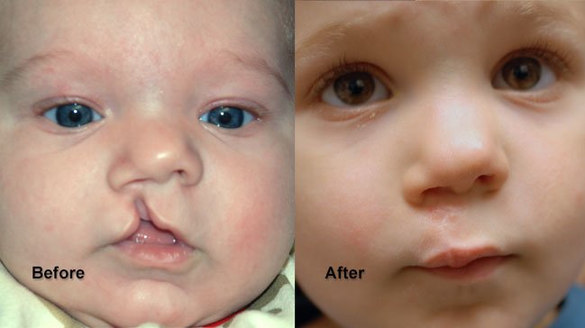 Before and after cleft lip and palate on baby
