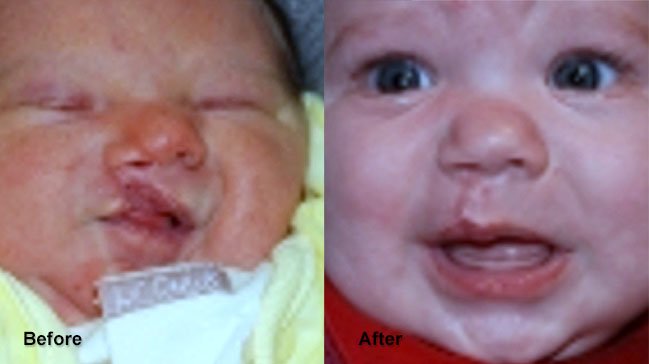 Before and after cleft lip and palate on baby