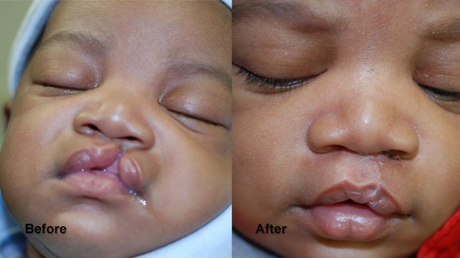 Before and after cleft lip and palate on baby