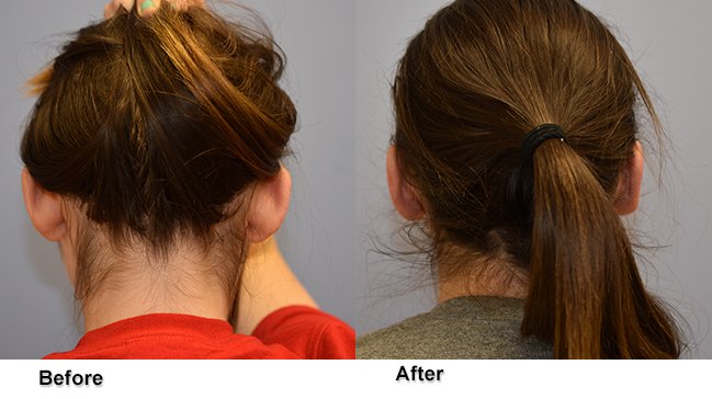 Back profile images of before and after ear revision surgery