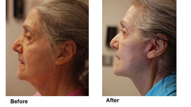 Side profile of woman before and after facelift