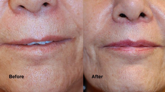 Before and after lip enhancement surgery