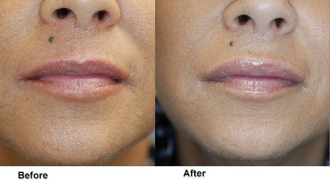 Before and after lip enhancement surgery