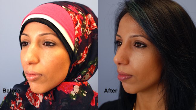 jones rhinoplasty 11