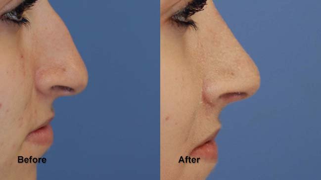 jones rhinoplasty 7