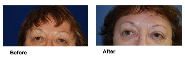Before and after upper eyelid surgery