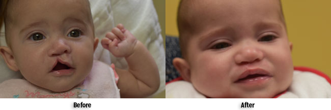 Before and after cleft lip and palate on baby