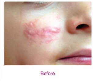 vbeam before photo 4