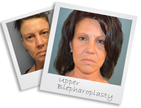 upperblepharoplasty