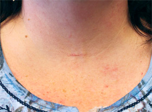 Picture of a woman’s throat with a coin to show the size of her minimally invasive scar from a thyroidectomy performed at Henry Ford Health a month after the surgery.
