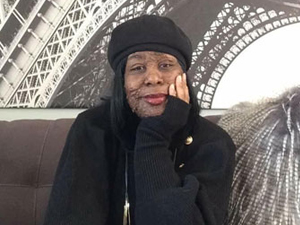 Neurofibromatosis patient, Tracy, sitting with one hand on her cheek