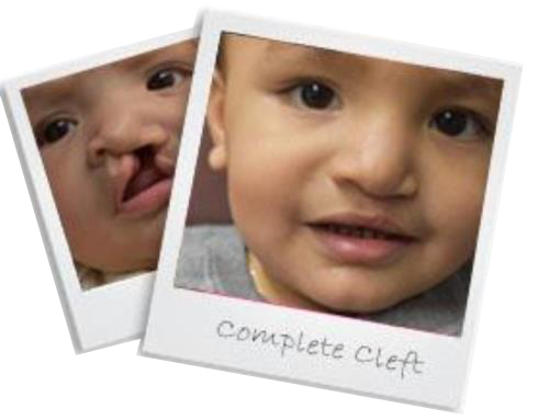 Complete Cleft Patient