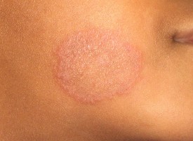fungus   ringworm face1 TAS
