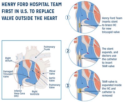 TricuspidValve