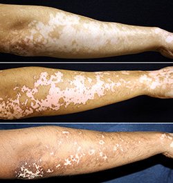 vitiligo