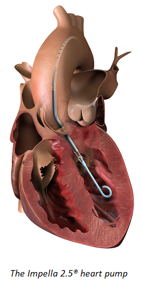 The Impella 2.5 Heart Pump