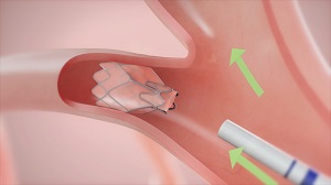 valve procedure for copd